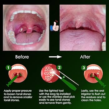 5 Great ways to Remove Tonsil Stones at Home